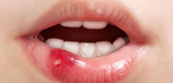 Ağız kanseri oral seks ile bulaşabilir